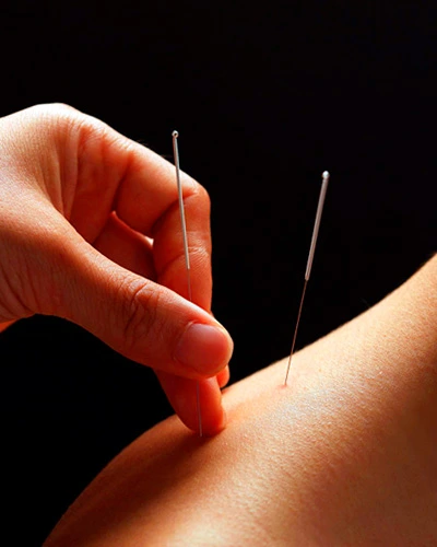 Процесс иглоукалывания